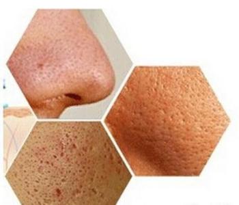 毛孔大是螨虫的原因吗,毛孔越来越多越来越大