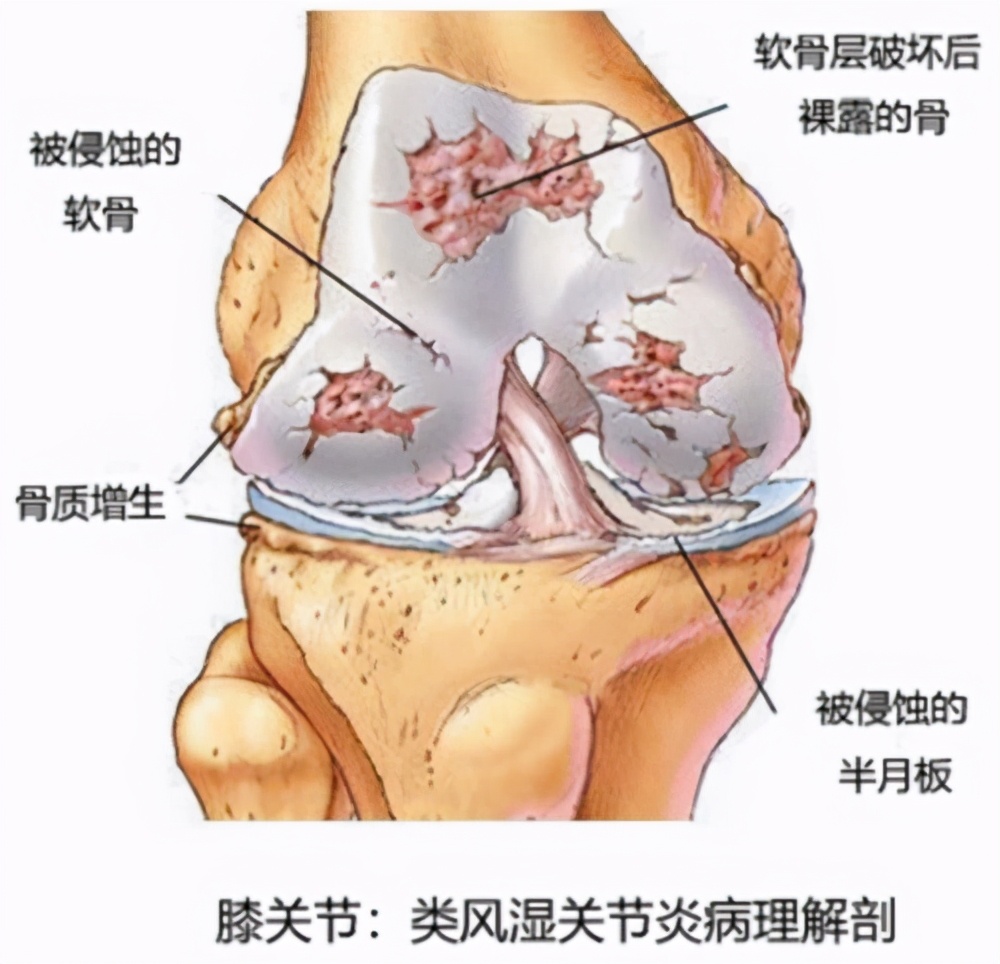 膝盖积液肿胀什么程度需要穿刺,膝盖积液一直有些肿是为什么