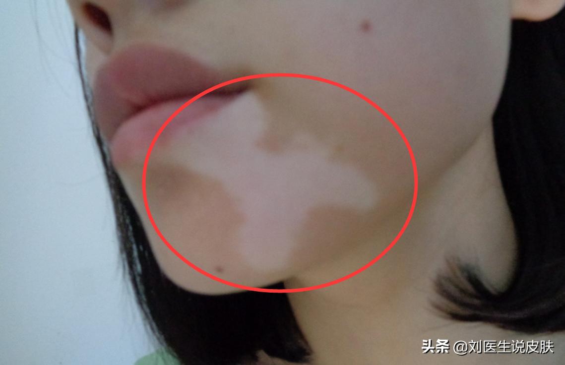 23岁女孩白癜风怎么治疗,29岁女人白癜风自愈
