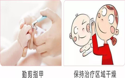 血管瘤破溃出血的预防和处理措施,血管瘤反复出血怎么办