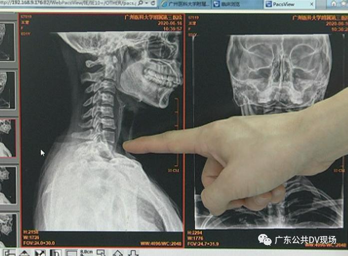 过山车导致脖子不舒服怎么办,女孩玩过山车意外变成了怪物