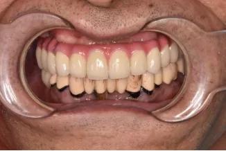 长沙牙齿种植的费用,长沙种植牙视频