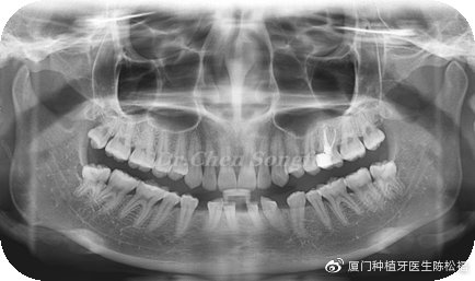厦门种植牙陈松福,口腔正畸案例分享