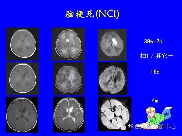 新生儿颅脑mri,新生儿颅脑mr报告模板