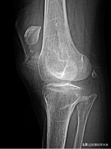 骨折的影像学检查及各自的优势,骨折的影像学愈合标准