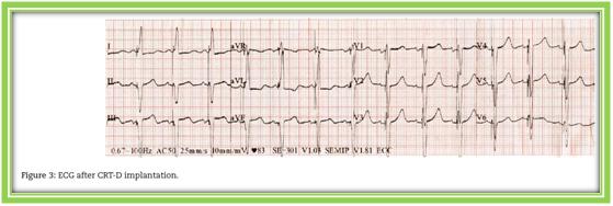 全麻拔管后意外气管破裂怎么办？