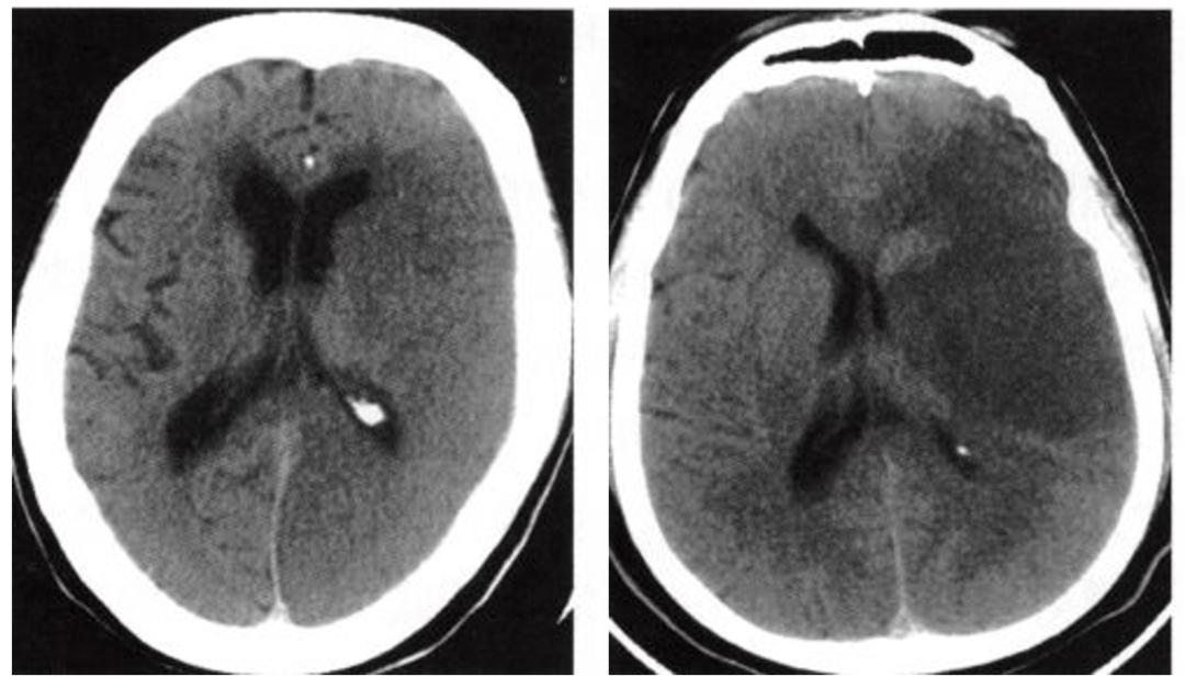 治疗脑梗死输什么液体最好,亚急性脑梗死怎么治疗最好