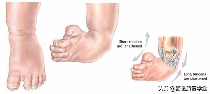 马蹄足内翻为什么一个大一个小,马蹄内翻足腿不一样大小怎么办