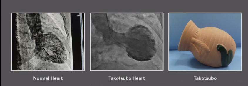 原来人心碎时，心脏会变成章鱼壶形