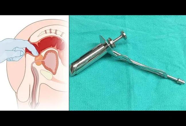 肛管癌与肛内尖锐性湿疣,肛管癌怎么检查能发现是肛管癌
