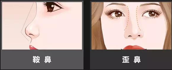 线雕隆鼻的注意事项有哪些,线雕隆鼻多长时间融为一体