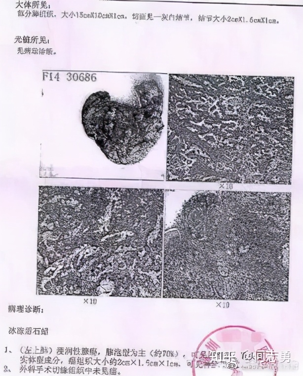 肺癌患者能不能不做基因检测，先用药呢？