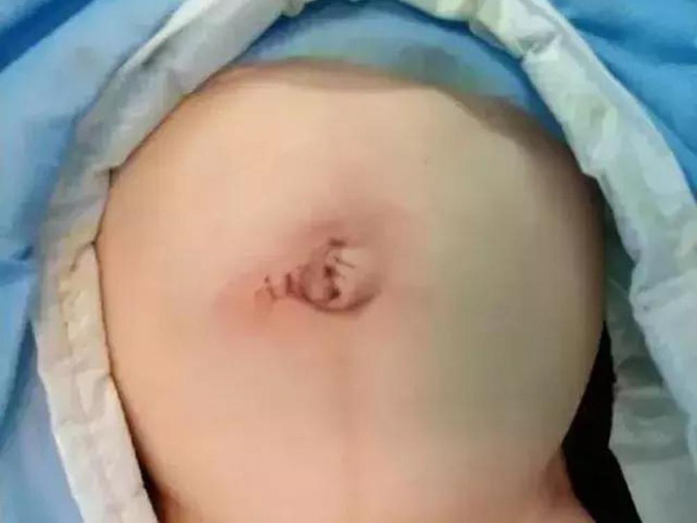 宝宝肚脐眼不消肿怎么回事,宝宝肚脐怎么处理