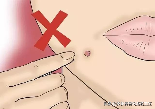 治疗痤疮用的避孕药有哪些,为什么治疗痘痘需要避孕药