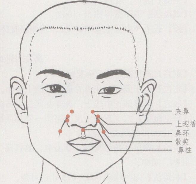 艾灸迎香穴治鼻炎视频,过敏性鼻炎可以按迎香穴吗