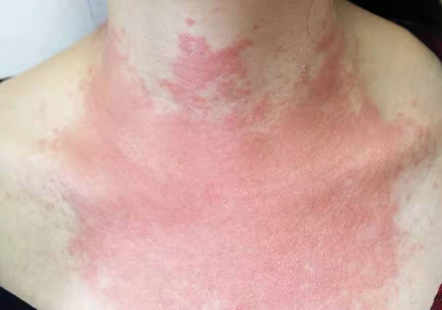 夏天戴项链会起疙瘩吗,夏天戴项链皮肤痒是怎么回事