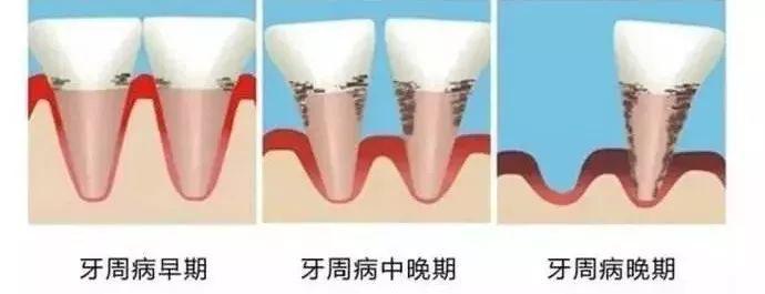口腔牙龈内壁小肉疙瘩怎么治疗,昆明牙科牙龈长小脓包