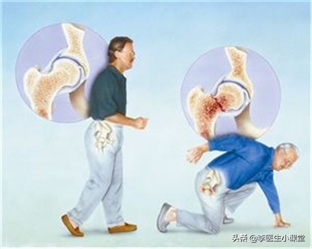 骨质疏松打一年一次的针能止疼吗,老年人骨质疏松最快的恢复办法