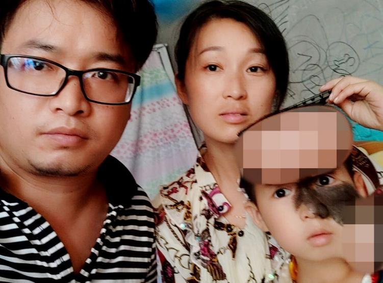 5岁男孩头上长500克重“气球”,历尽5年艰辛只为早日换脸