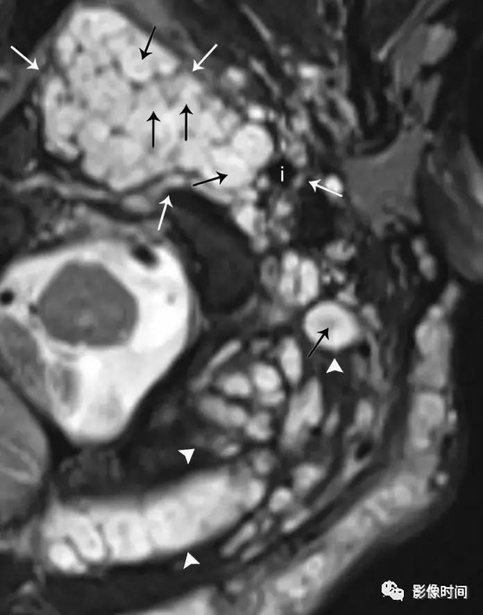 双侧颈动脉鞘间隙多发小淋巴结影,双侧颈动脉间隙多软组织密度结节