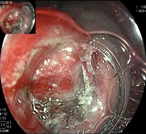 贲门隆起性病变影像,贲门溃疡隆起性病变