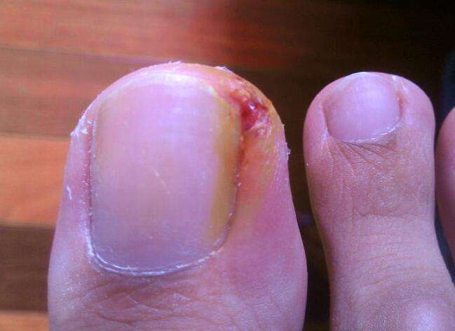 甲沟炎治好了以后怎么防止复发,甲沟炎的预防及有效处理方法