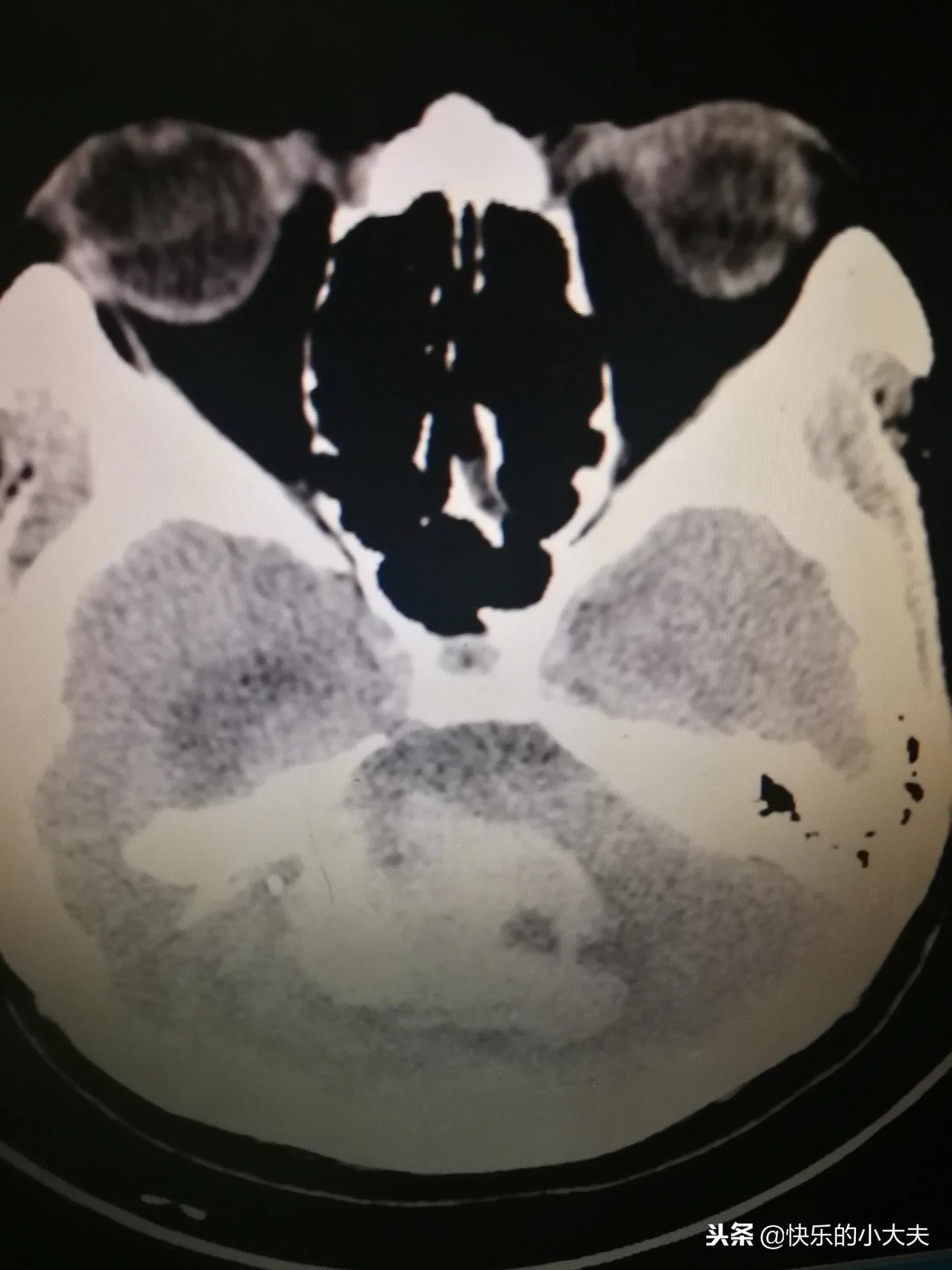 icu病房抢救过来的真实感受,icu里的病人没有意识吗意味着什么