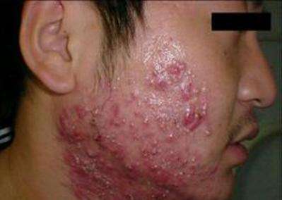 痘痘反反复复该如何根治,痘痘感染成红色疙瘩一直不消