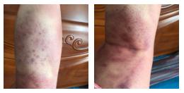 拍打膀胱有什么好处,拍打膀胱有助排尿吗