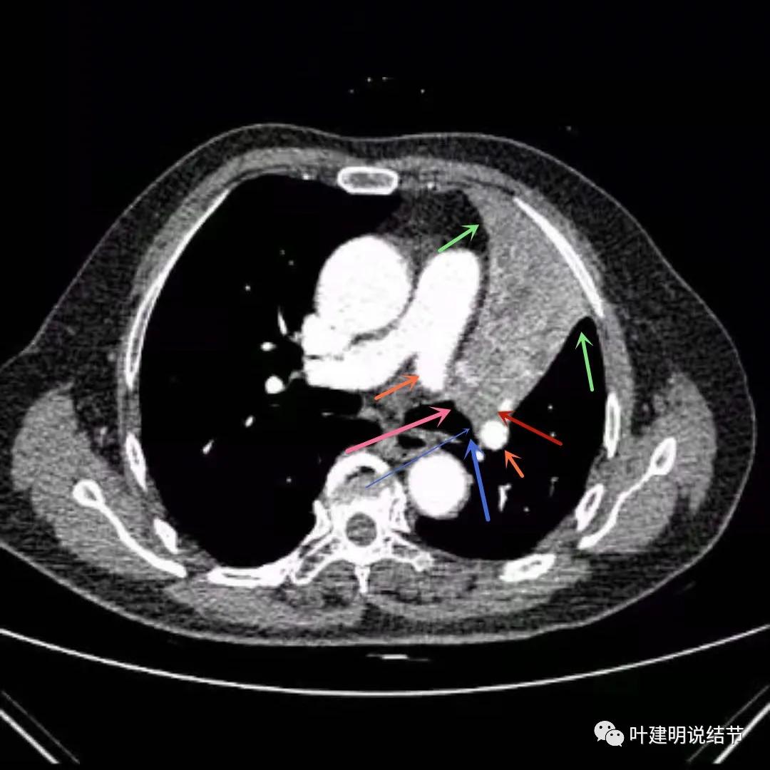 高龄肺癌靶向治疗效果,高龄老人肺癌早期适合放疗吗