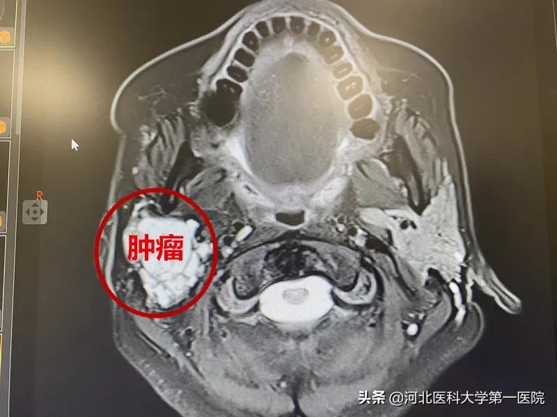 神奇魔法刀,一点就消!点亮肿瘤绝境患者,再生的希望之光