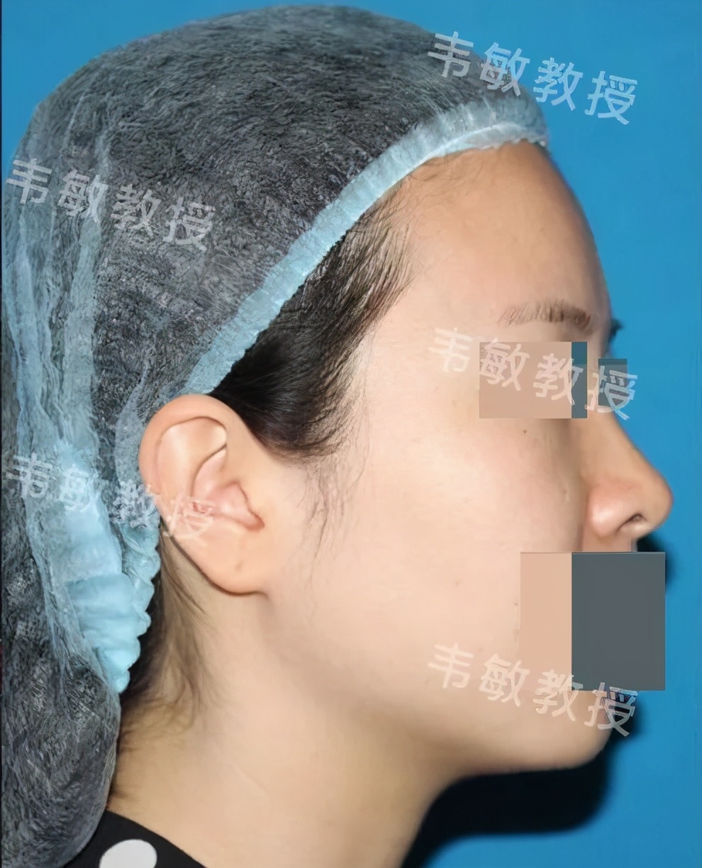 塌鼻子如何变成尖鼻子,形态欠佳怎么回事