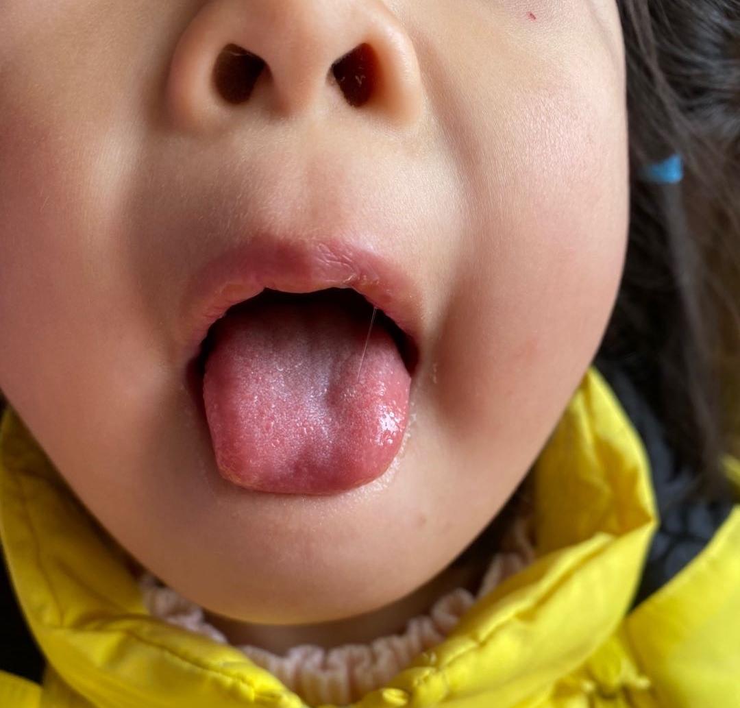 孩子睡觉老是脚心发热怎么回事,睡觉热了就扁桃体发炎