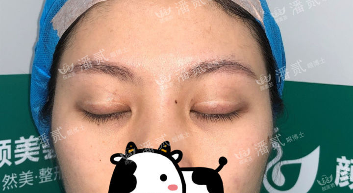 肿眼泡抽脂肪埋线双眼皮效果,肿眼泡割双眼皮长脂肪