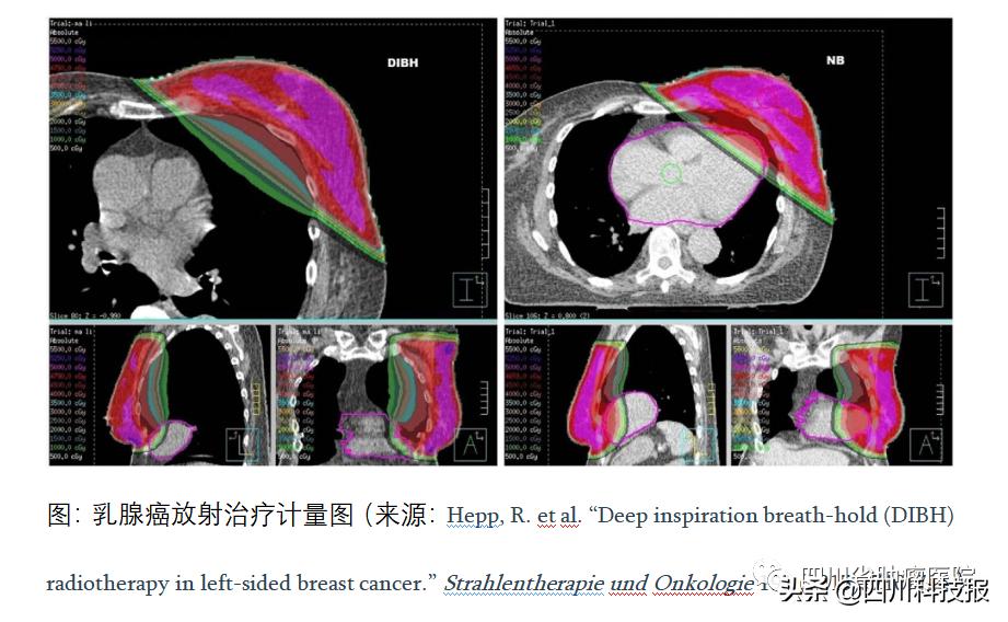 乳腺癌有几种放疗方案,乳腺癌核素治疗方法