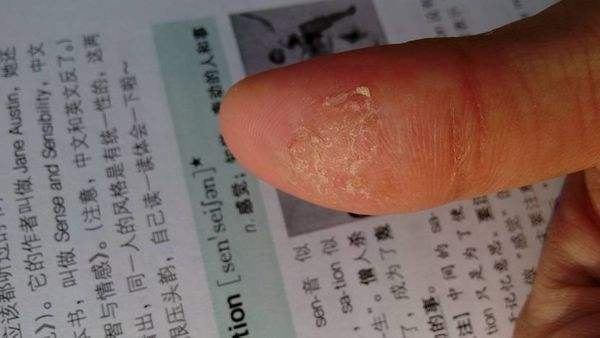手脚长小水泡奇痒难忍教你一招,手脚起水泡奇痒无比什么办法最好