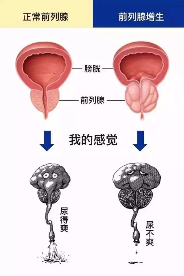 47岁男的前列腺增生有什么影响,40岁以上的男性要警惕前列腺增生