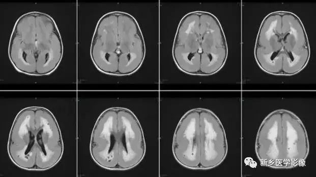 影像学脑室扩大,脑室显大怎么理解