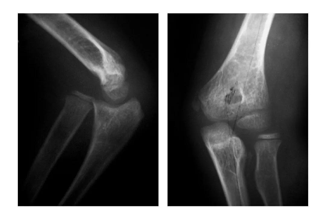 青少年肘部损伤最常见的是,肘部桡神经损伤的临床表现