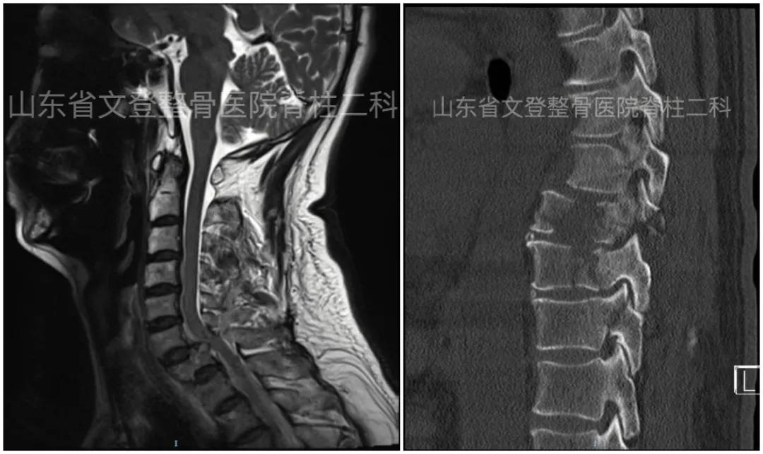 文登整骨医院治疗截瘫,山东文登整骨医院治疗怎么样