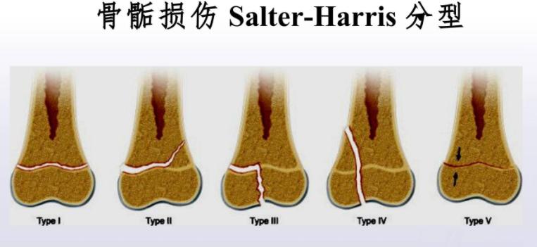 儿童骨骺骨折是什么意思,儿童严重的骨骺骨折有哪些