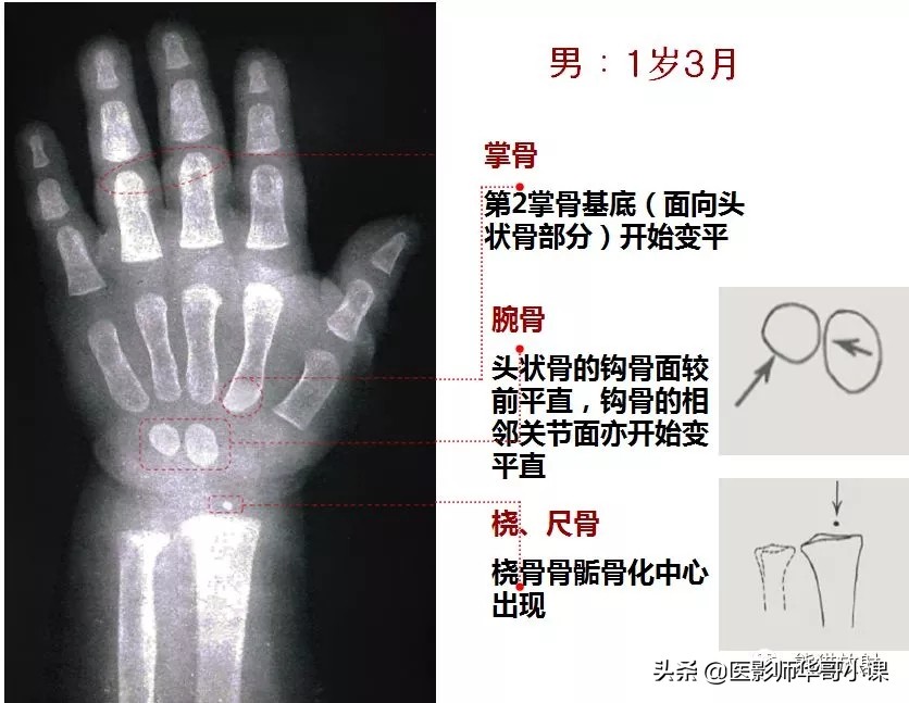 骨龄片对照图谱测骨龄准不,骨龄14岁男孩骨龄图谱