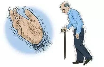 帕金森综合症中医经方治疗医案,早期的帕金森治愈成功案例