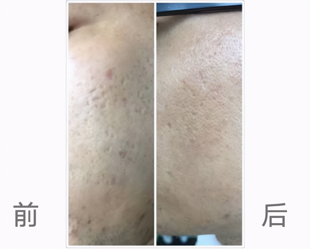 长痘留下的疤能消除吗,长痘留下的毛孔真的恢复不了了吗