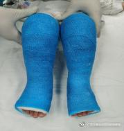 马蹄内翻足孩子的康复,成人马蹄足内翻康复治疗