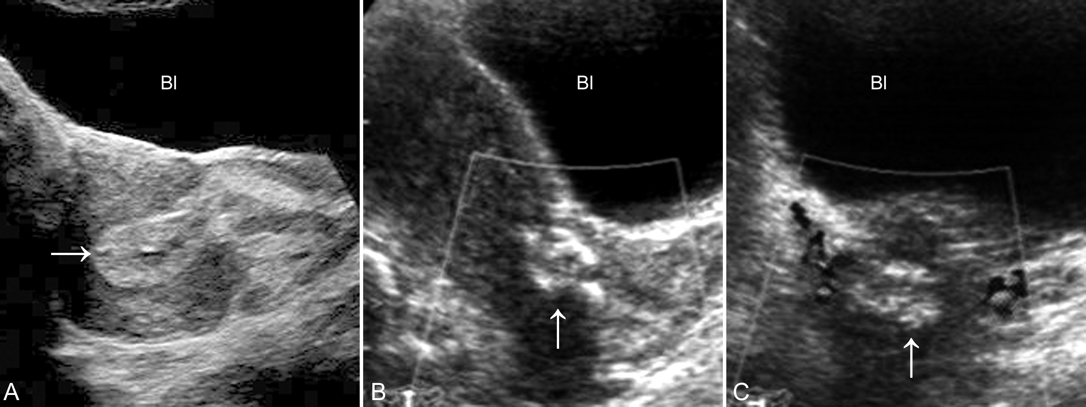 明明白白做超声32-3:流产:超声检查