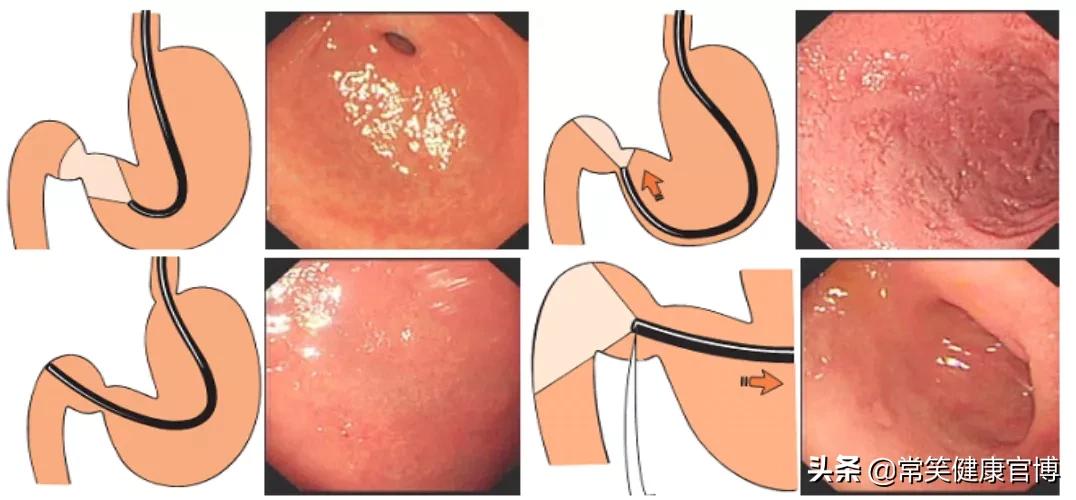 胃镜检查后要注意什么？3件事，有的人不以为意