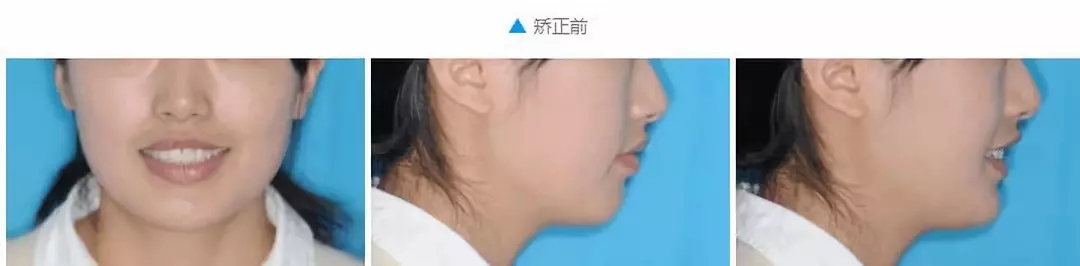 深覆盖vs深覆合,深覆盖和深覆合哪个难度大