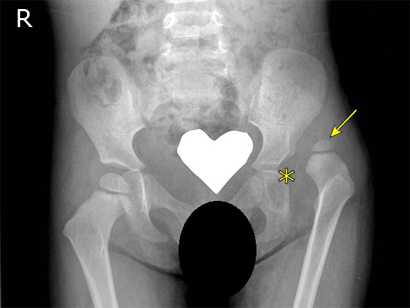 髋关节发育不良吃什么药效果最好,轻微髋关节发育不良可以不治疗吗