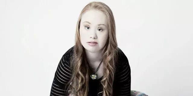 唐氏综合征中国美女,患有唐氏综合征的维密模特